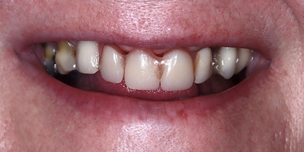 Partial denture  - before treatment